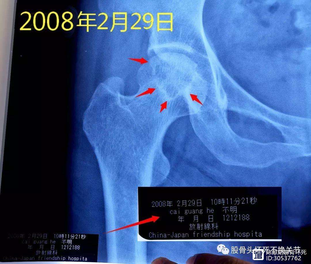 丽水人工骨头医保报销多少(人工骨头医保报销多少比例)