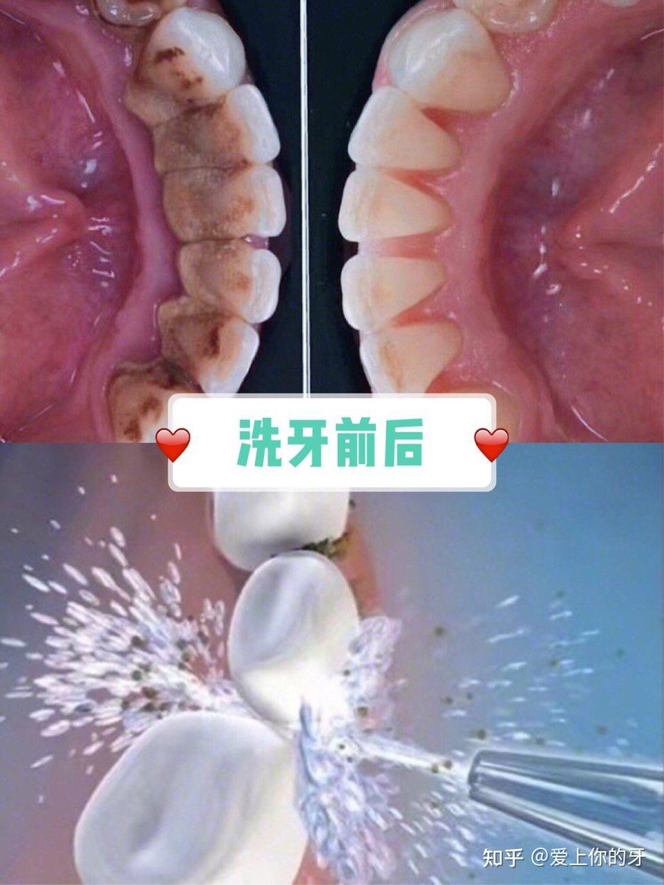 丽水洗牙可以用医保吗(洗牙可以用医保吗,报销比例多少)